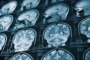 Diagnosing a Traumatic Brain Injury